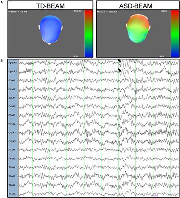 Case report: A novel frameshift mutation in BRSK2 causes autism in a 16-year old Chinese boy